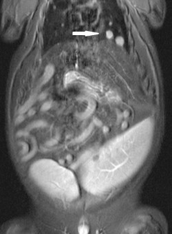 MRI Prostate Mass 4