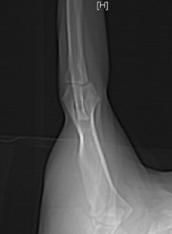 Elbow Dysplasia 1