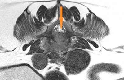MRI Prostate Mass 2