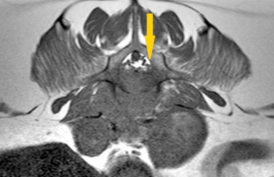 MRI Prostate Mass 3