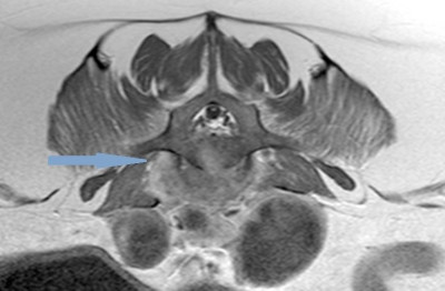 MRI Prostate Mass 6