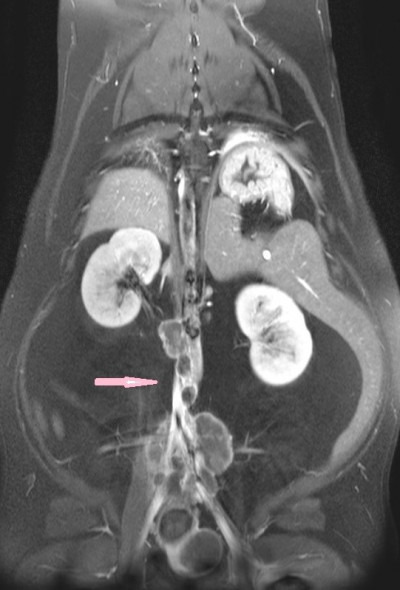 MRI Prostate Mass 8