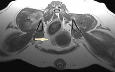 MRI Prostate Mass 10