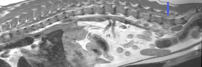 MRI Prostate Mass 5